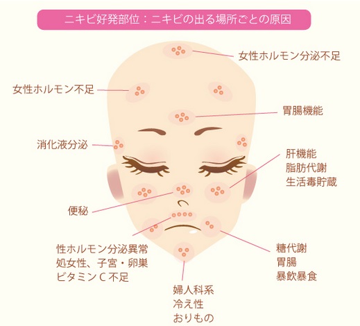 にきびの出来る場所